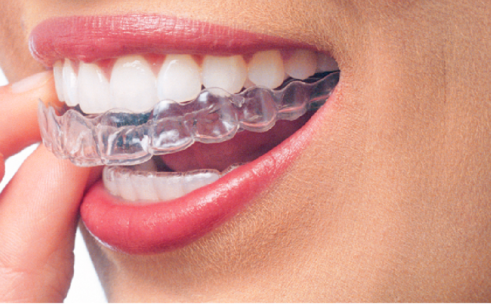 Invisalign- Global Estetik Dental Care
